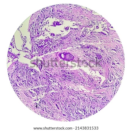 Calcinosis cutis of histology image analyzed by light microscope.