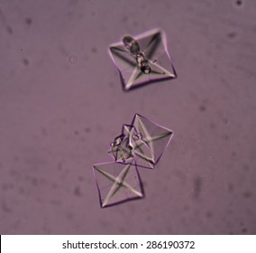 Calcium Oxalate Crystal In Urine Analysis.