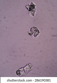 Calcium Oxalate Crystal In Urine Analysis.