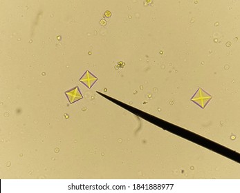 Calcium oxalate crystal Images, Stock Photos & Vectors | Shutterstock