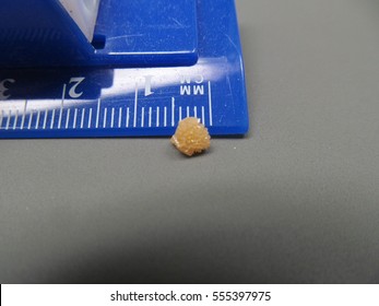 Calcium Oxalate Kidney Stone Closeup