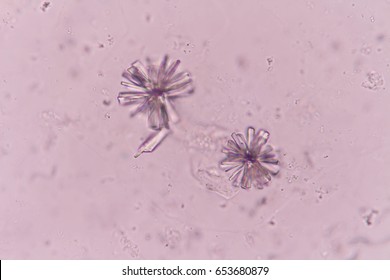 Calcium Phosphate Crystals (Rosette Shape) In Urine Analysis