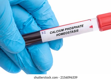 Calcium Phosphate Homeostasis. Calcium Phosphate Homeostasis disease blood test in doctor hand