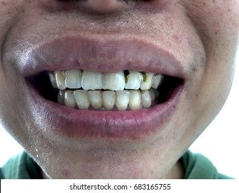 tartar between teeth