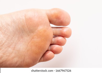 Callous Skin Tissue On Human Foot Sole Isolated On White With Copy Space