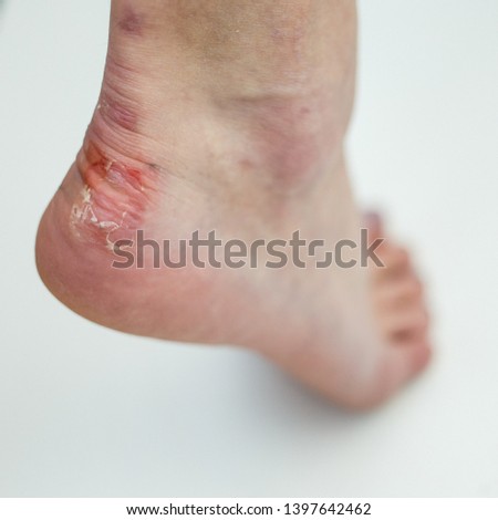 
Callus on the leg of a young girl. female foot with problem areas on the skin, dry callus. 