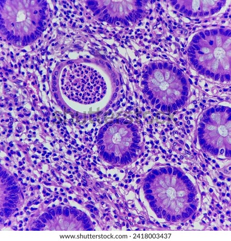 Camera photo of active colitis showing crypt abscess, magnification 400x, photograph through a microscope