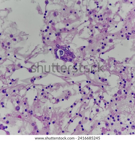 Camera photo of cluster of adenocarcinoma with psammoma bodies in cytology, magnification 400x, photograph through a microscope