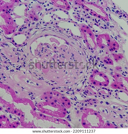 Camera photo of focal segmental glomerulosclerosis, showing segmental obliteration of capillary lumen, magnification 400x, HE stain