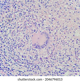 Camera Photo Of Multinucleated Giant Histiocyte In Lymph Node Of Patient With Tuberculosis, Magnification 400x, Photograph Through A Microscope