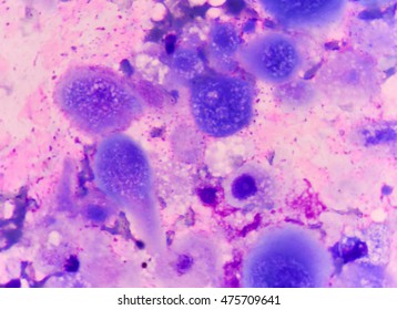 Cancer Cell In Human Showing Abnormal Cells.Medical Science Background Concept.