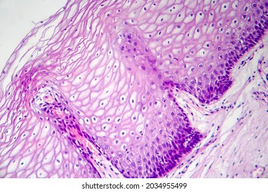 Cancer Of Cervix. Light Micrograph, Photo Under Microscope. Histopathology Of Cervical Cancer