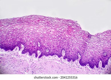 Cancer Of Cervix. Light Micrograph, Photo Under Microscope. Histopathology Of Cervical Cancer