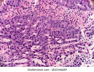 Cancer Of The Stomach With Gland Formation Called Adenocarcinoma. Low Grade Acute Inflammation Near The Tumor Nests.  Microscopic View.