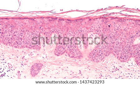 Cancer of Sun Damaged Skin: In squamous cell carcinoma in situ (