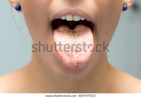 infeccion micotica lengua