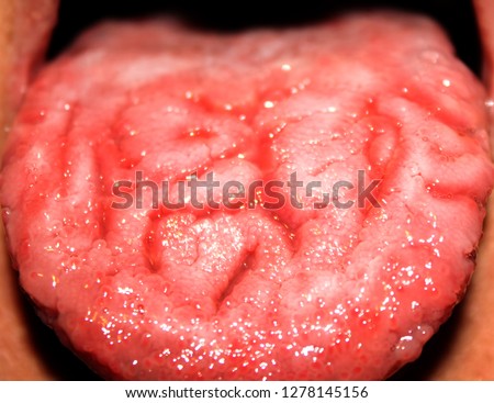 Candidiasis in the tongue. White coating. Fractured tongue. Thrush.