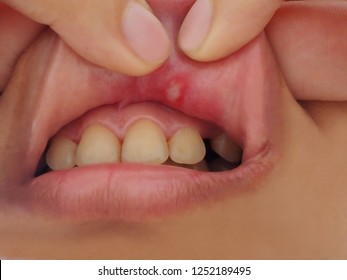 Canker Sore Or Mouth Ulcer Is That Occurs On The Mucous Membrane Of The Oral Cavity In The Asian Woman.