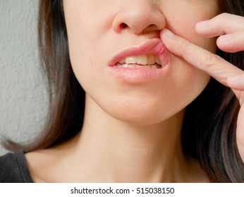 Canker sore on woman upper lip - Shutterstock ID 515038150