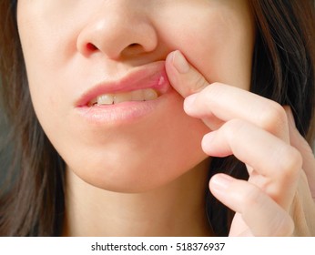Canker sore or ulcer mouth on woman upper lip - Shutterstock ID 518376937