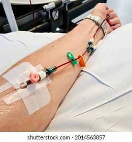 Cannula For Intravenous Iron Infusion