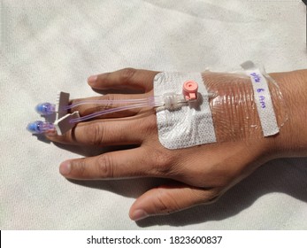 Cannula In Right Arm Of Indian Man Held Down By Tape As A Surgical Aid To IV Intravenous Drip , Take Blood From A Patient Inserted Into A Vein In Hospital Selective Focus On Hand