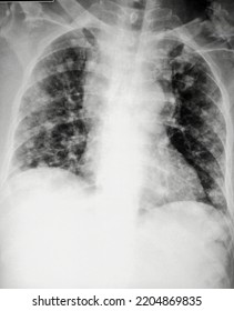 Canon Ball Lesion In The Chest Xray Suggestive Of Metastatic Disease.