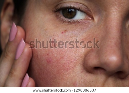 capillaries on the girl's face
