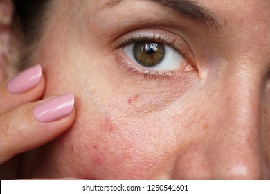 capillaries on the skin of the face - Shutterstock ID 1250541601
