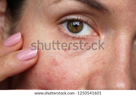 capillaries on the skin of the face