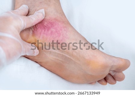 Capillary bleeding and petechiae caused by varicose veins on elderly patient’s leg, Vascular pathology, small hemorrhages, red spots and vessel damage, Doctor touches irritated skin area