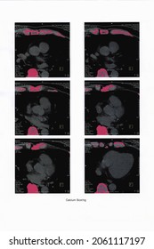 Cardiac CT Image Report For Calcium Scoring Use For Medical Doctor As An Indicator To Diagnosis Of Atherosclerosis Or Coronary Artery Disease (CAD)