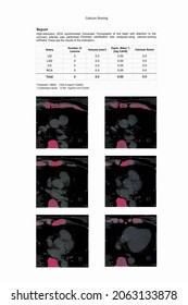 Cardiac CT Image Report For Calcium Scoring Use For Medical Doctor As An Indicator To Diagnosis Of Atherosclerosis Or Coronary Artery Disease (CAD)