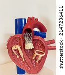 cardiac model of Transcatheter aortic valve implantation (TAVI) for people education