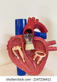 cardiac model of Transcatheter aortic valve implantation (TAVI) for people education