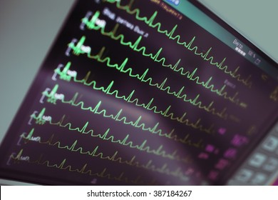 Cardiac Monitoring In Intensive Care.