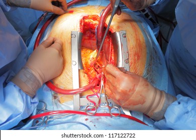 Cardiac Surgery. An Open Wound.