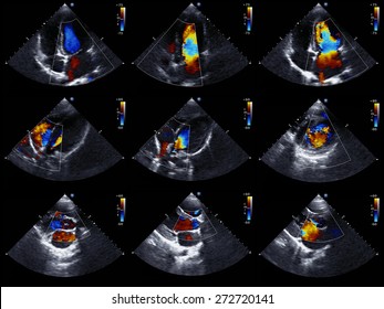 Cardiac ultrasound images / color Doppler echo