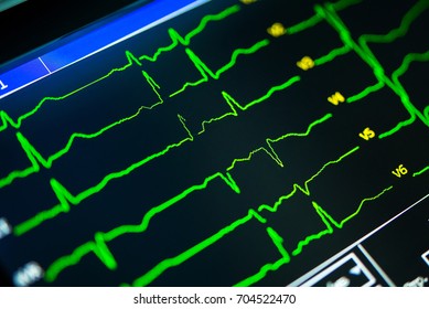 cardiogram close-up on a cardiograph monitor
