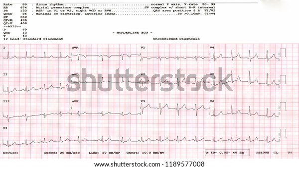 Borderline Ecg