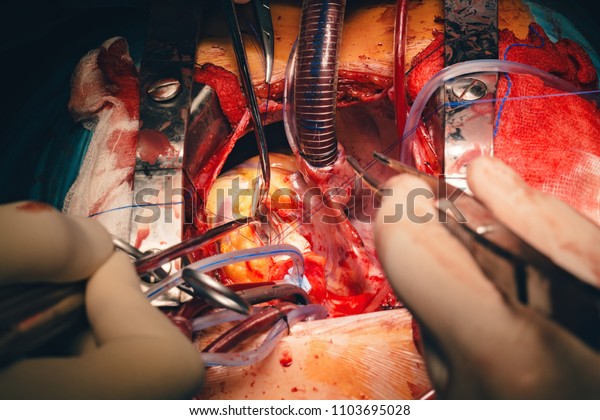 Cardiovascular
surgery doctor in surgery center for interventions with instruments
in surgeon operation electrosurgery with thoracotomy microsurgery
doing minimal invasive open heart
surgery