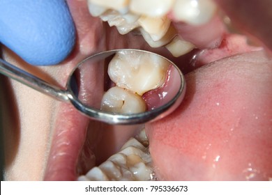 caries of the frontal tooth is photographed through a dental mirror close-up