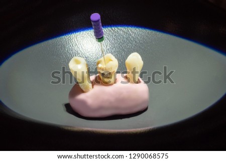 Caries in the tooth. Removing a nerve in a tooth. Pulpitis. Dental treatment.