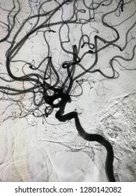 Carotid Angiogram At Right Internal Carotid In Cathlab, In R/o Right Internal Carotid Stenosis,old Cva ,stroke