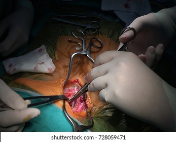 Carotid artery surgery, carotid endarterectomy procedure