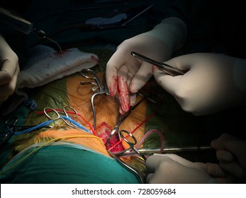 Carotid artery surgery, carotid endarterectomy procedure with temporary artery shunt