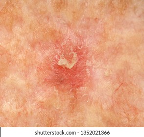 A Case Of Actinic (solar) Keratosis.