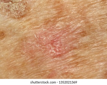 A Case Of Actinic (solar) Keratosis.