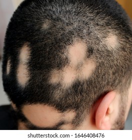 A Case Of Alopecia Areata In A Male