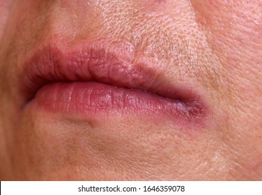 A Case Of Angular Cheilitis Caused By Candida Infection In A Female With Diabetes
